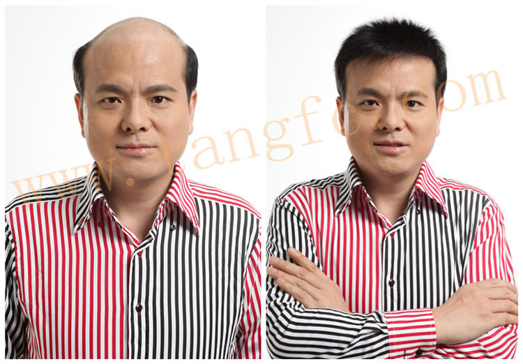男士頭發(fā)稀少增發(fā)后 \