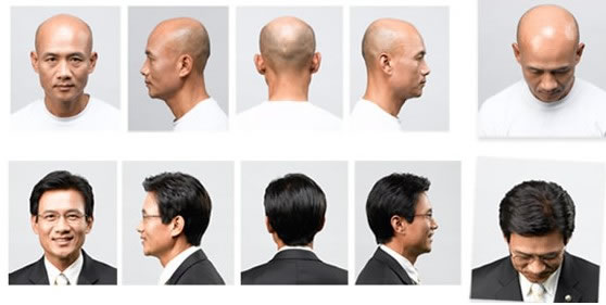 廣州這邊禿頂怎么辦？可以修復(fù)么？