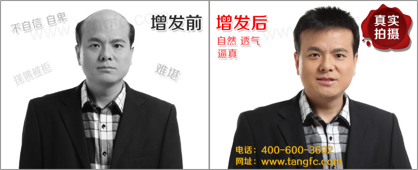 男士禿頂是普見的現(xiàn)象么？