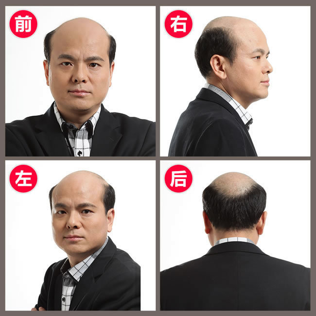 前額兩邊頭發(fā)稀疏怎么辦？看了你就知道怎么解決！