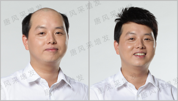 白發(fā)織發(fā) 白發(fā)脫發(fā)可不可以進行織發(fā)?