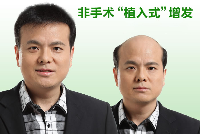 明星也織發(fā)，織發(fā)哪個牌子好？