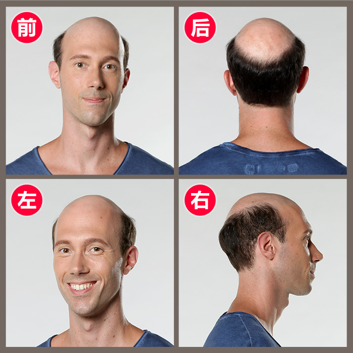 補頭發(fā) 補頭發(fā)的食物有哪些 如何改善嚴重脫發(fā)