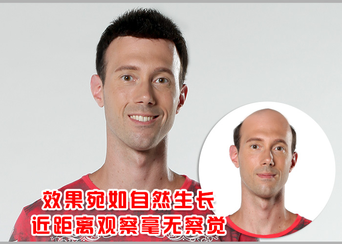 假發(fā)套真發(fā) 頭發(fā)稀少怎么辦 假發(fā)套真發(fā)怎能錯(cuò)過