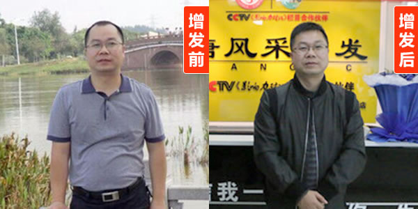 頭發(fā)再生的方法有哪些？看了你就知道了！