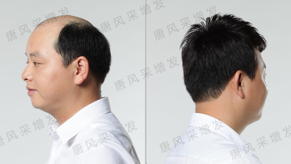 嘉興假發(fā)專賣店 嘉興假發(fā)專賣店已成功為42661人解決了頭發(fā)煩惱