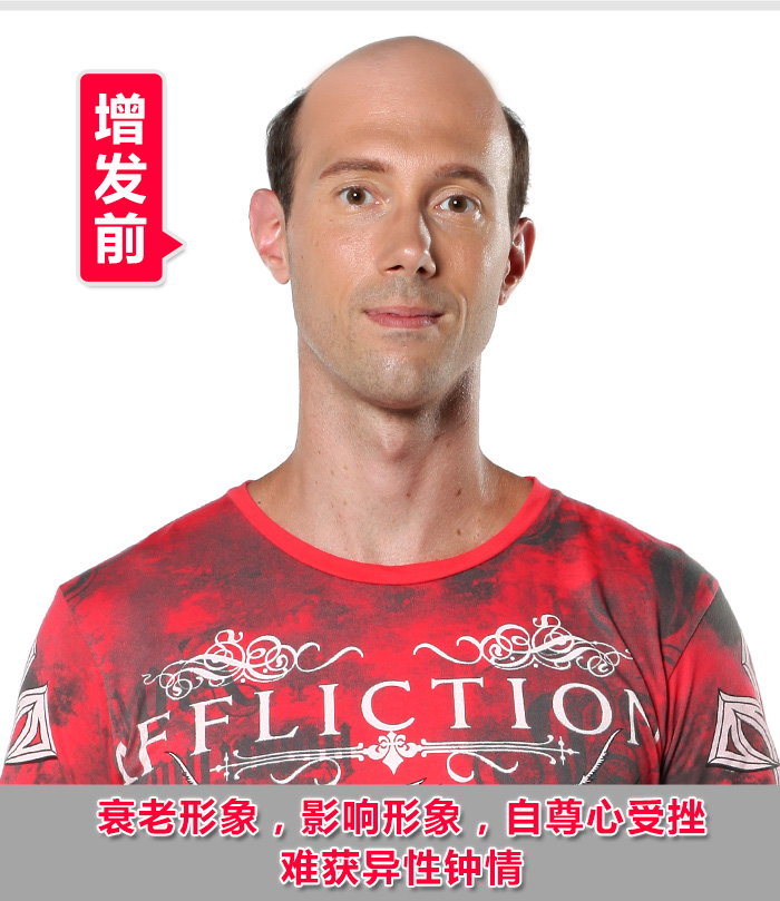 常德織發(fā)補(bǔ)發(fā)哪家好？靠譜的織發(fā)補(bǔ)發(fā)才是關(guān)鍵！