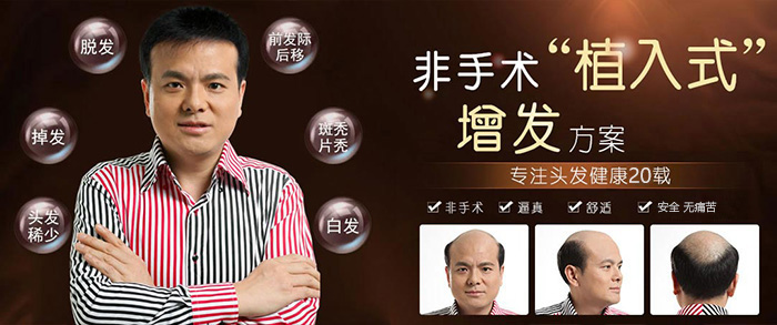 佛山織發(fā)補發(fā)需要多少錢？識貨者請往這看