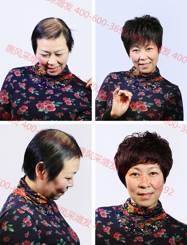 合肥織發(fā)定制解決脫發(fā)，什么品牌值得信賴？