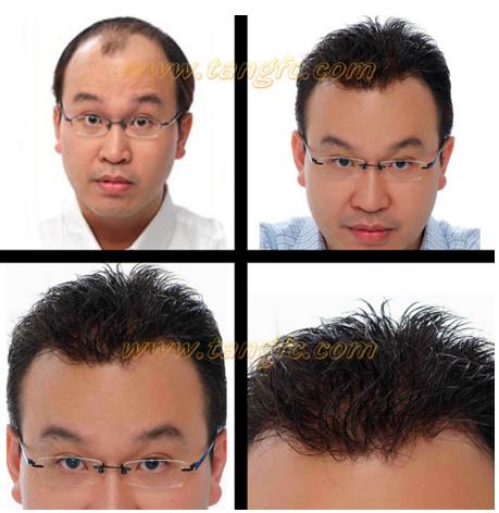 來自NASA的黑科技生發(fā)頭盔，禿頂有救了？
