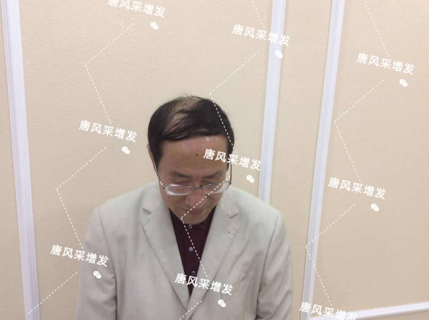脫發(fā)禿頂成中年男人標(biāo)配？唐風(fēng)采增發(fā)讓您風(fēng)采始終如一