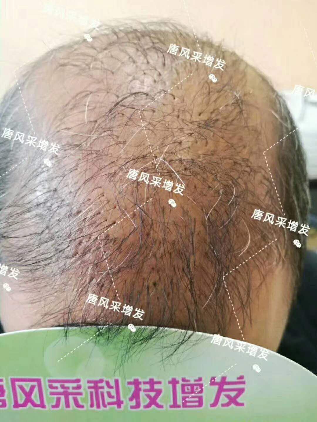 頭發(fā)稀少怎么變密？
