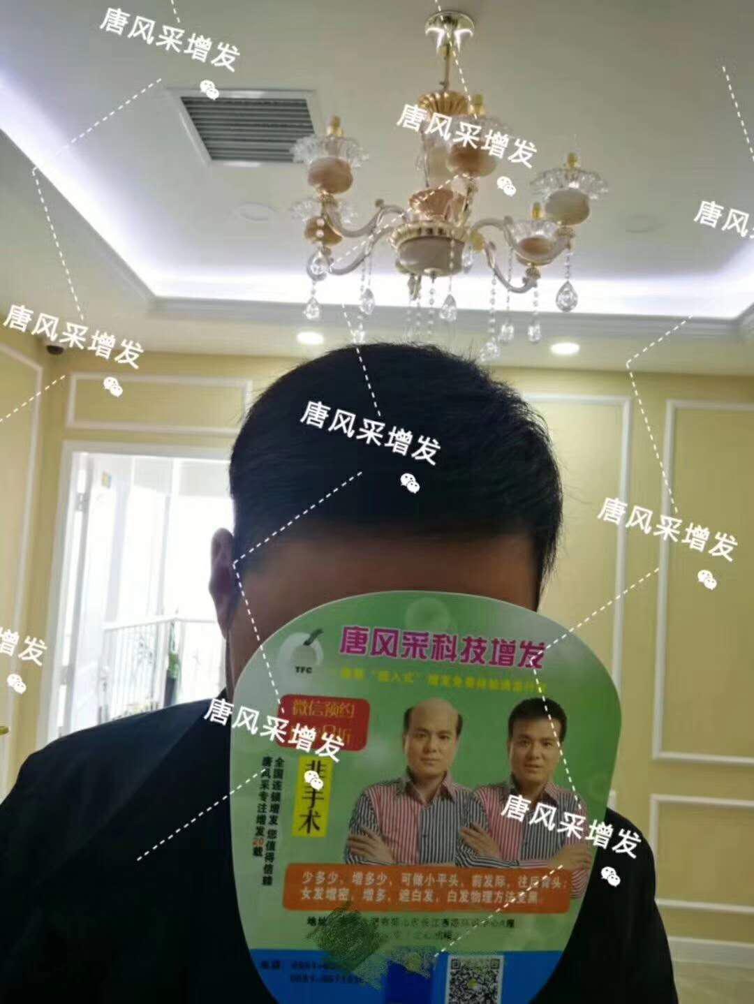頭發(fā)稀少怎么變密？