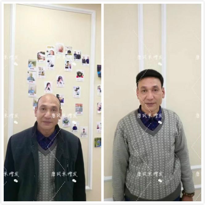 頭發(fā)少怎么辦？