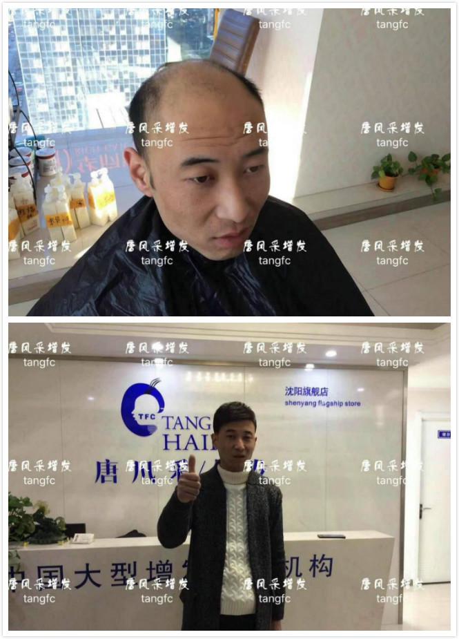 為脫發(fā)者解千愁，增發(fā)前后的驚人對(duì)比！