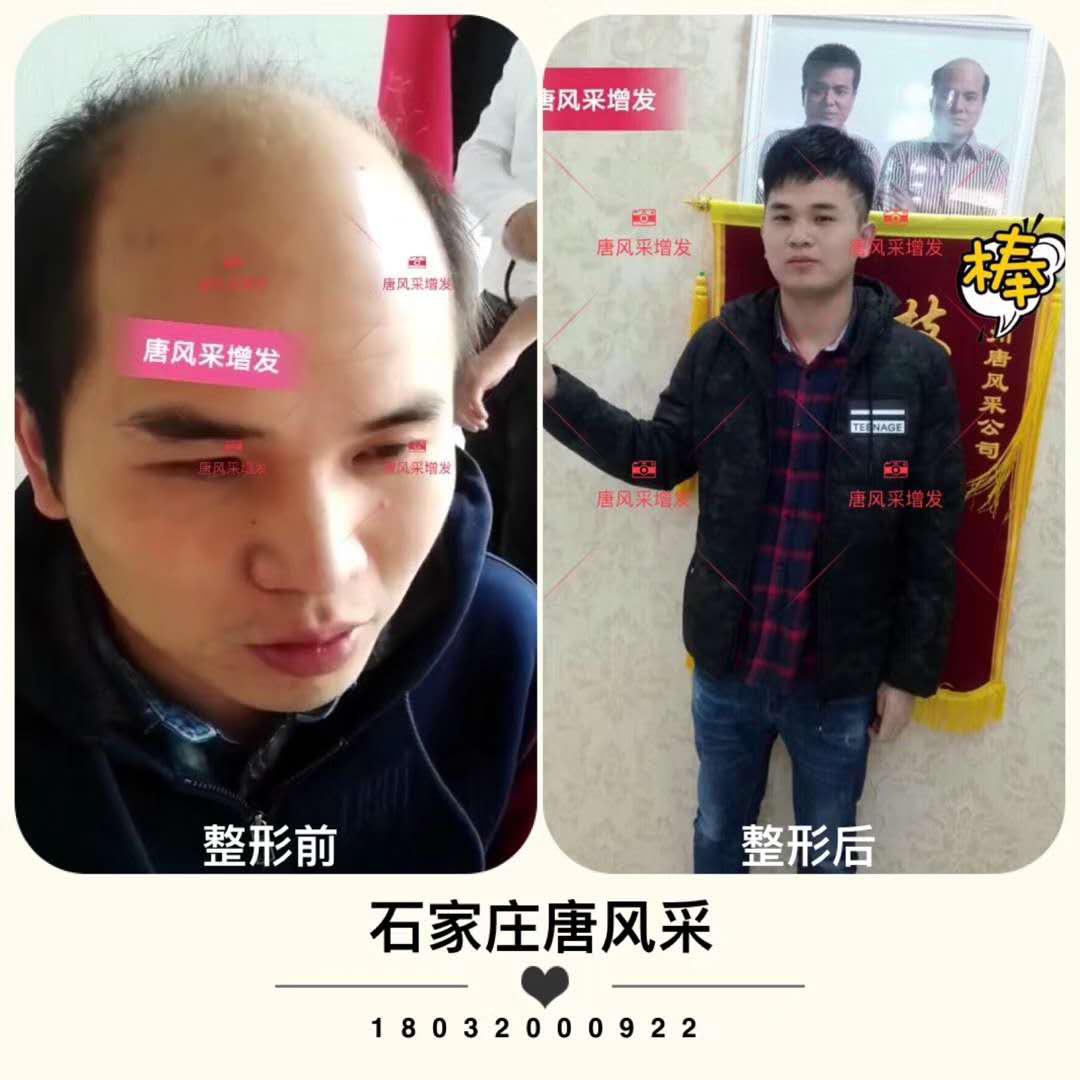 頭發(fā)少怎么辦？
