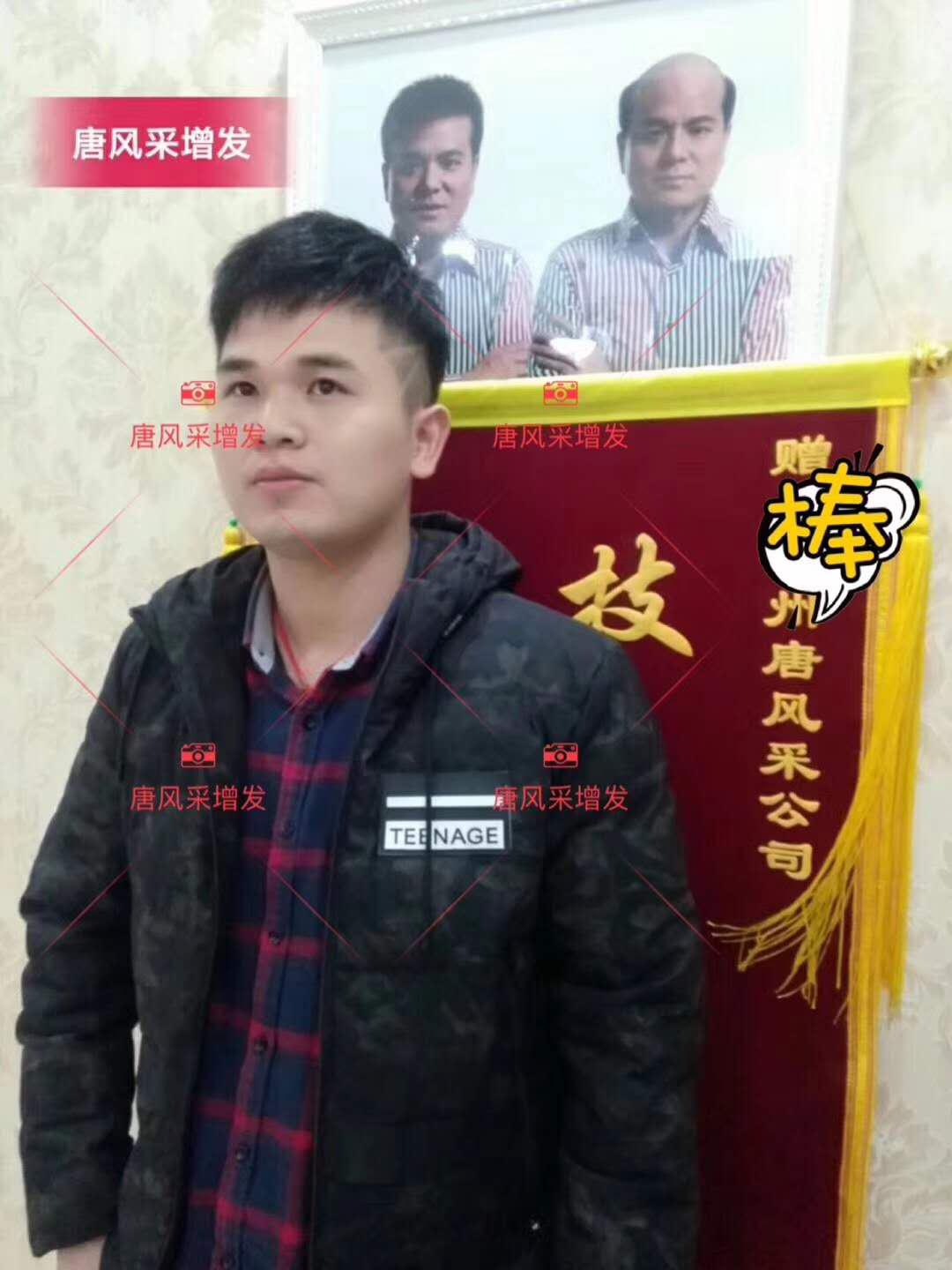 為脫發(fā)者解千愁，增發(fā)前后的驚人對(duì)比！
