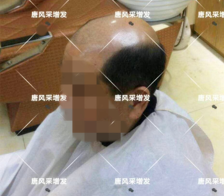 男人脫發(fā)原因多，不能一味怨腎虧！