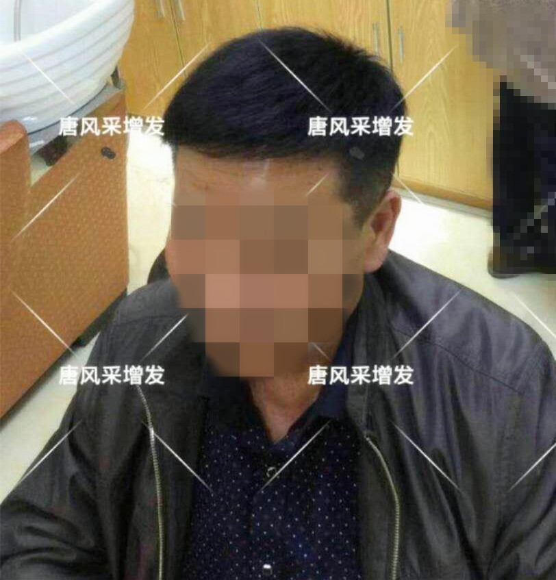 男人脫發(fā)原因多，不能一味怨腎虧！