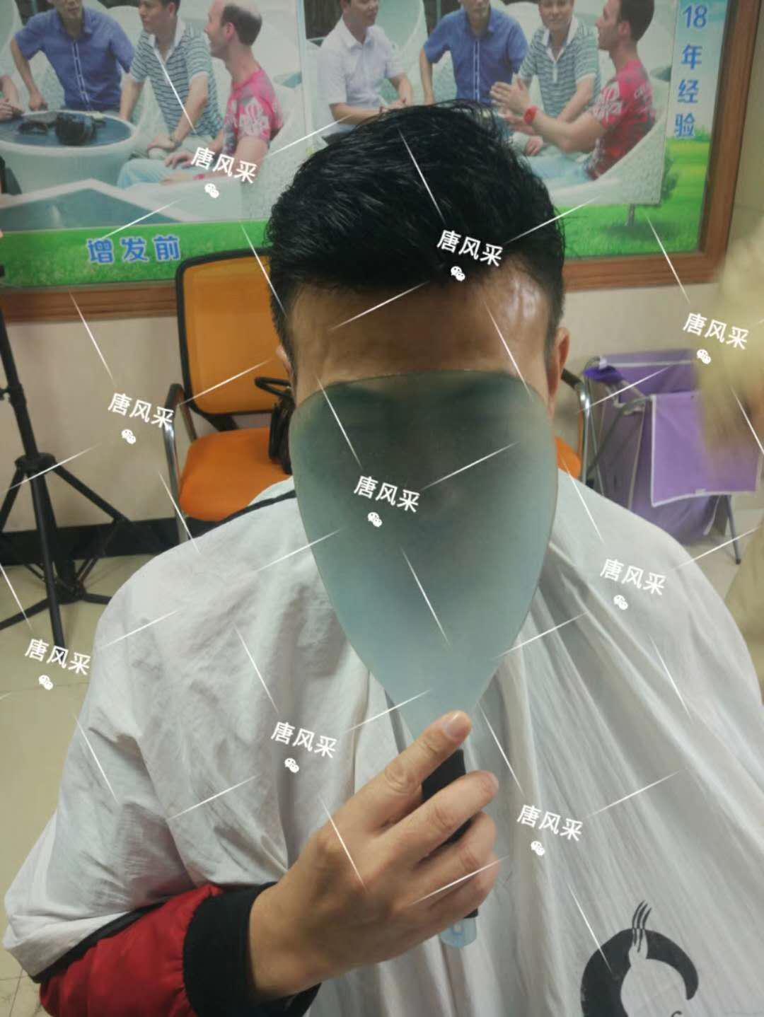 男人脫發(fā)原因多，不能一味怨腎虧！