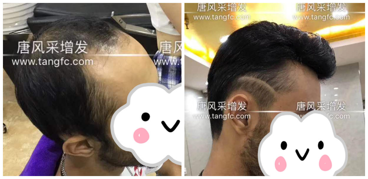 男士假發(fā)容易看出來嗎？看看做過頭發(fā)的發(fā)友怎么說！