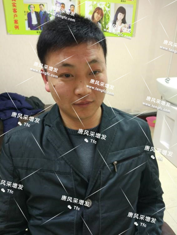 人民公仆也脫發(fā)，廈門(mén)夏先生增發(fā)記