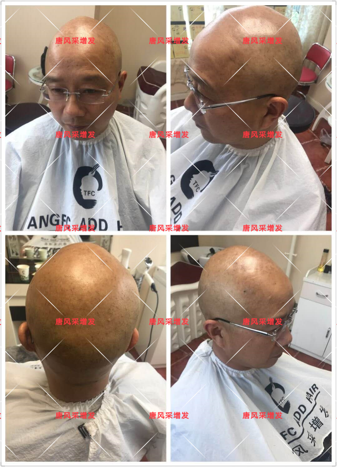 10年脫發(fā)困擾，一次性解決，唐風(fēng)采助力查先生“夢(mèng)想成真”