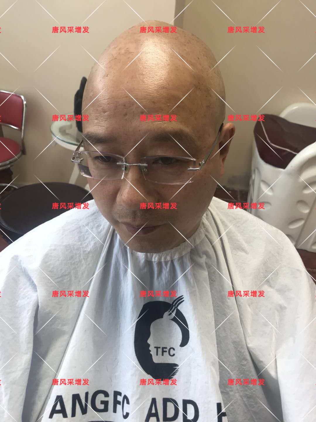 10年脫發(fā)困擾，一次性解決，唐風(fēng)采助力查先生“夢(mèng)想成真”