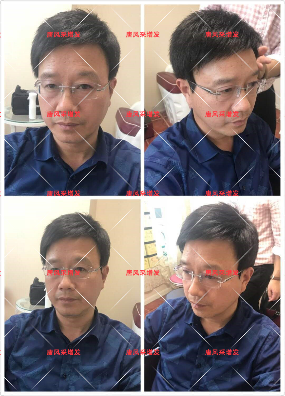 10年脫發(fā)困擾，一次性解決，唐風(fēng)采助力查先生“夢(mèng)想成真”