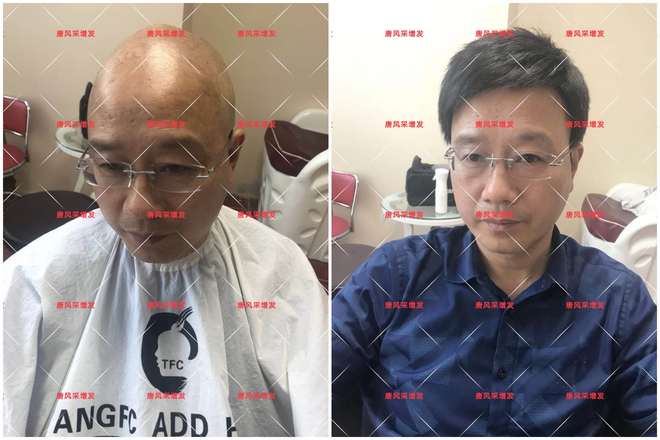 10年脫發(fā)困擾，一次性解決，唐風(fēng)采助力查先生“夢(mèng)想成真”