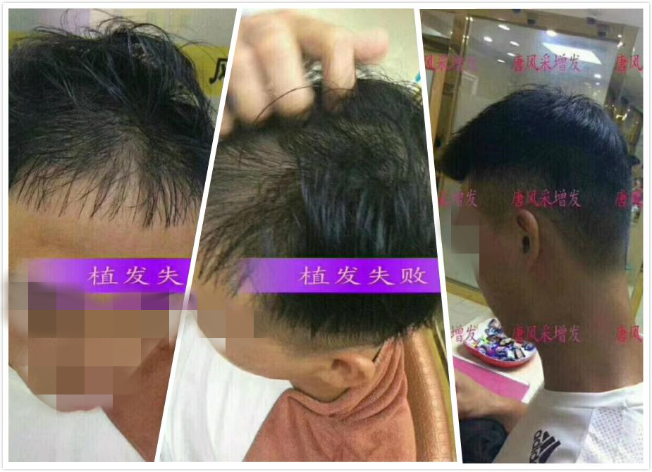 開(kāi)始脫發(fā)的朋友上醫(yī)院，見(jiàn)到專(zhuān)家后他徹底絕望了！