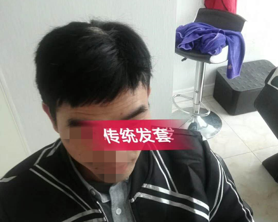 開(kāi)始脫發(fā)的朋友上醫(yī)院，見(jiàn)到專(zhuān)家后他徹底絕望了！
