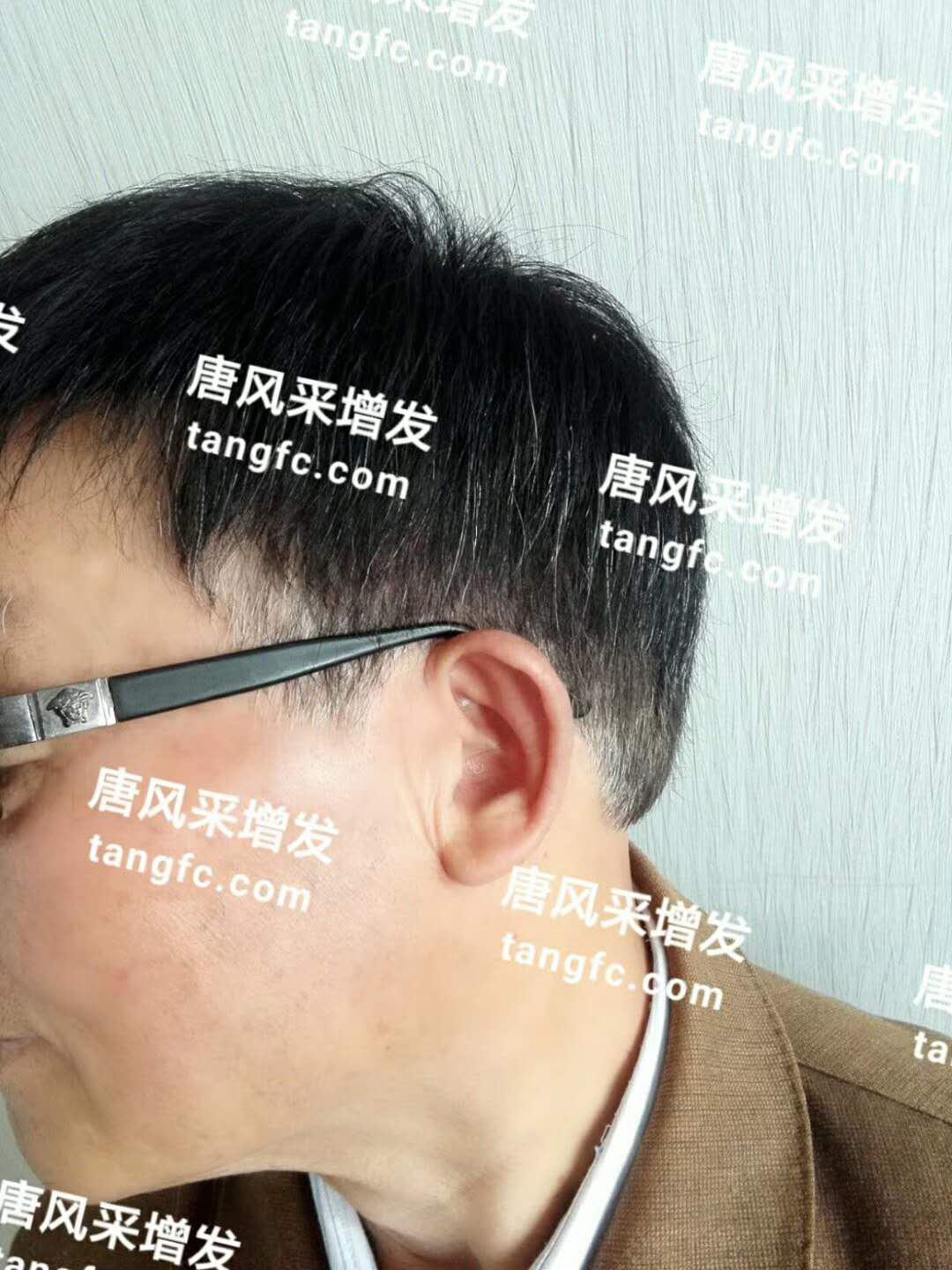 開(kāi)始脫發(fā)的朋友上醫(yī)院，見(jiàn)到專(zhuān)家后他徹底絕望了！