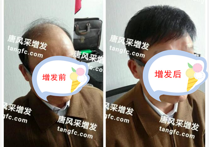 開(kāi)始脫發(fā)的朋友上醫(yī)院，見(jiàn)到專(zhuān)家后他徹底絕望了！
