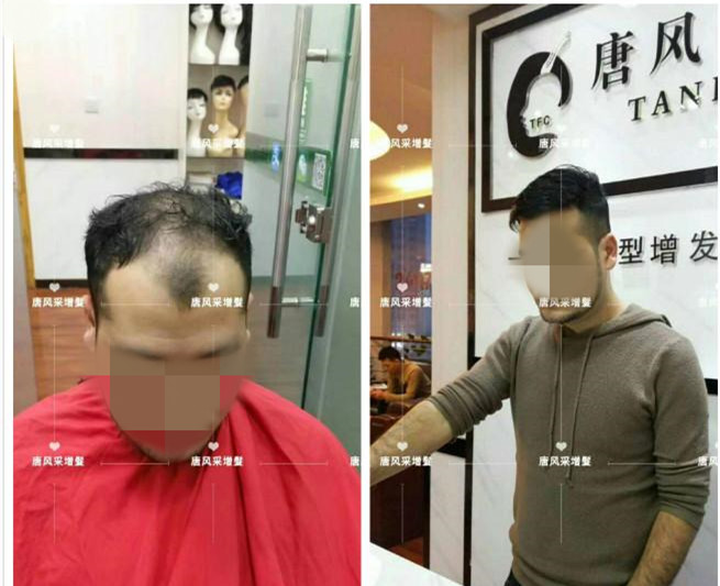 謝頂是顏值也拯救不了的尷尬！
