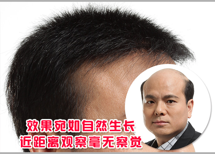 別再嘲笑我，我的禿頂已經(jīng)解決了！