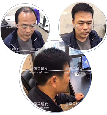 如何避免成為一個(gè)脫發(fā)的中年猥瑣男人？