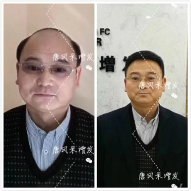 如何避免成為一個(gè)脫發(fā)的中年猥瑣男人？