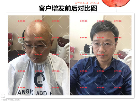 雙節(jié)同慶，給脫發(fā)的父親什么禮物，讓父親“年輕10歲”的神