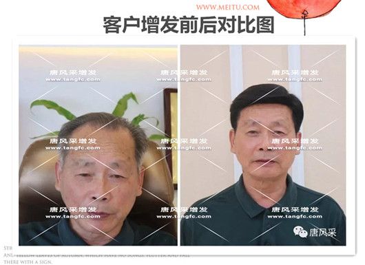 雙節(jié)同慶，給脫發(fā)的父親什么禮物，讓父親“年輕10歲”的神
