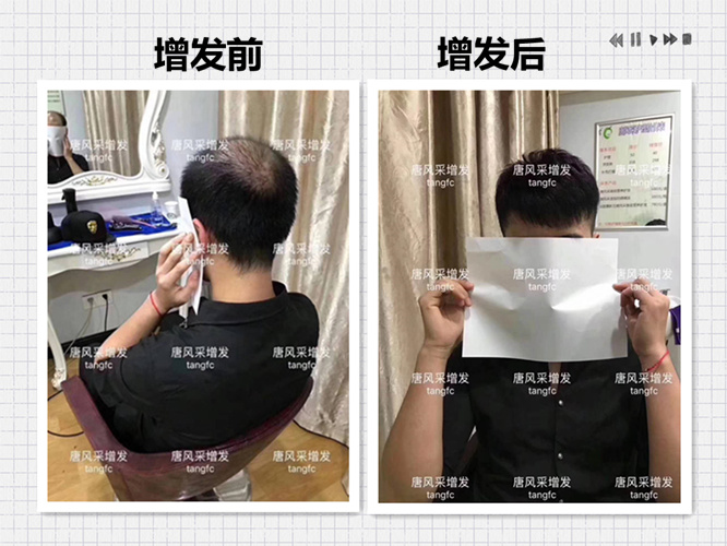 西寧補(bǔ)發(fā)哪里好誰知道？ 90后脫發(fā)了想做補(bǔ)發(fā)！