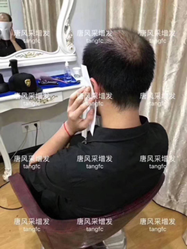 西寧補(bǔ)發(fā)哪里好誰知道？ 90后脫發(fā)了想做補(bǔ)發(fā)！
