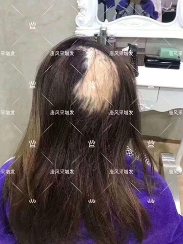 西寧織發(fā)補(bǔ)發(fā)需要多少錢,哪家補(bǔ)發(fā)技術(shù)好？