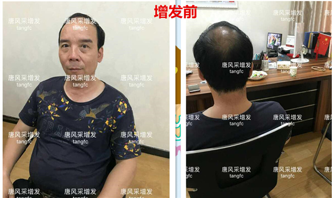 如何生發(fā)密發(fā)?到底有沒有生發(fā)奇效的藥物呢？
