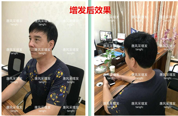 如何生發(fā)密發(fā)?到底有沒有生發(fā)奇效的藥物呢？