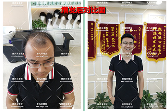 他被脫發(fā)“啃老”是與遺傳有關(guān)??！