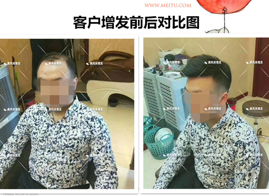 防偷防盜防不了發(fā)際線, 變禿頂了怎么辦？