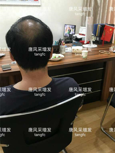 朋友碰面不敢認，直擊發(fā)友增發(fā)后的真實改變！