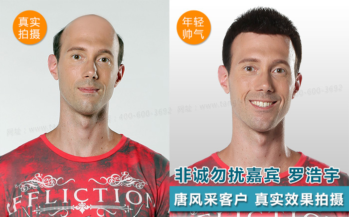 臺(tái)州哪里買假發(fā)好，頭發(fā)稀疏適合什么樣的假發(fā)？