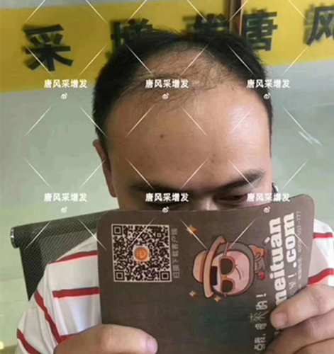 西寧織發(fā)補發(fā)哪家好，真的能改變我的脫發(fā)形象嗎？ 